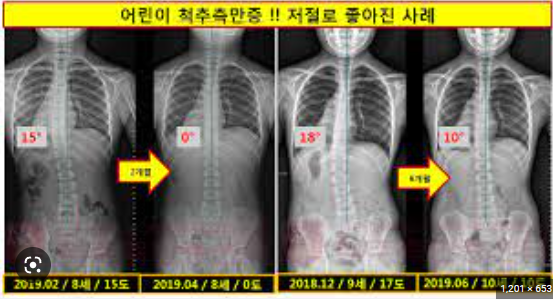 ▲전문의들은 이아들의 척추측만증의 경우 주기적인 관찰 중 척추가 휘어진 각도가 5도 안팎으로 달라질 수 있어 가능하다면 비슷한 시간대 병원을 방문하고 한 병원에서 꾸준히 관리하는 것이 좋다고 조언한다. <사진=SNS>