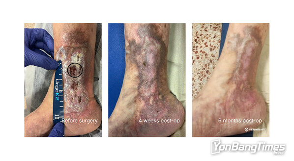 Restorative effect of replacing diseased vein with fully biological P-TEV personalized tissue engineered vein